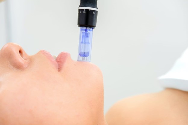 microneedling